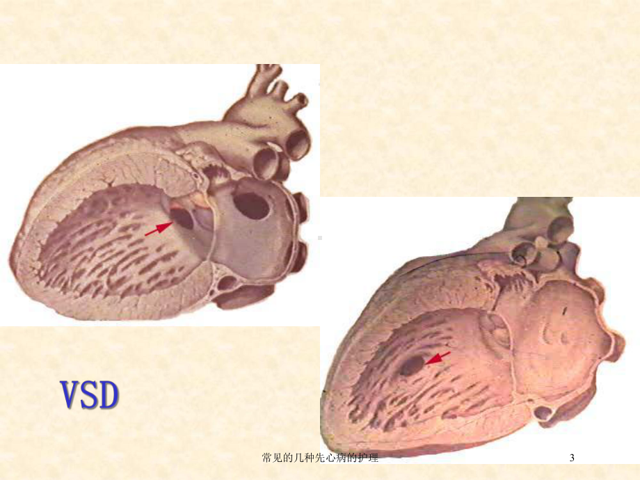 常见的几种先心病的护理培训课件.ppt_第3页