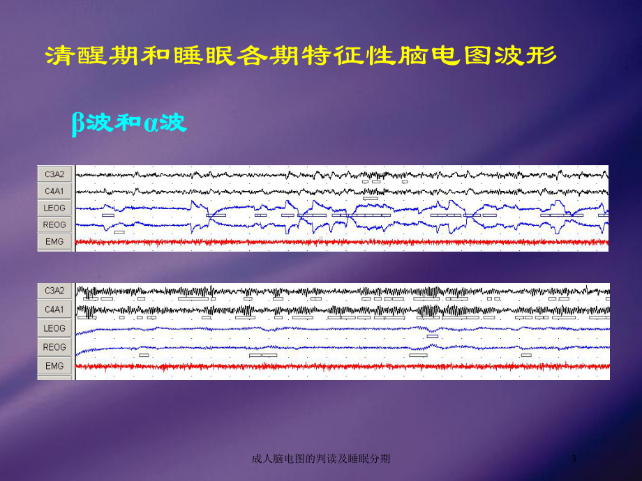 成人脑电图的判读及睡眠分期培训课件.ppt_第3页