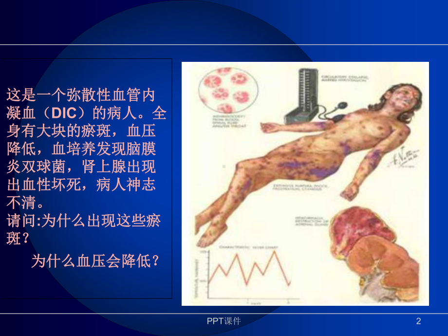 弥漫性血管内凝血--课件.ppt_第2页