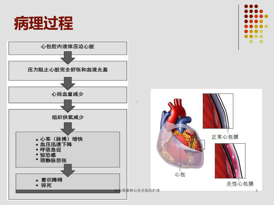 心包填塞和心包引流的护理培训课件.ppt_第3页