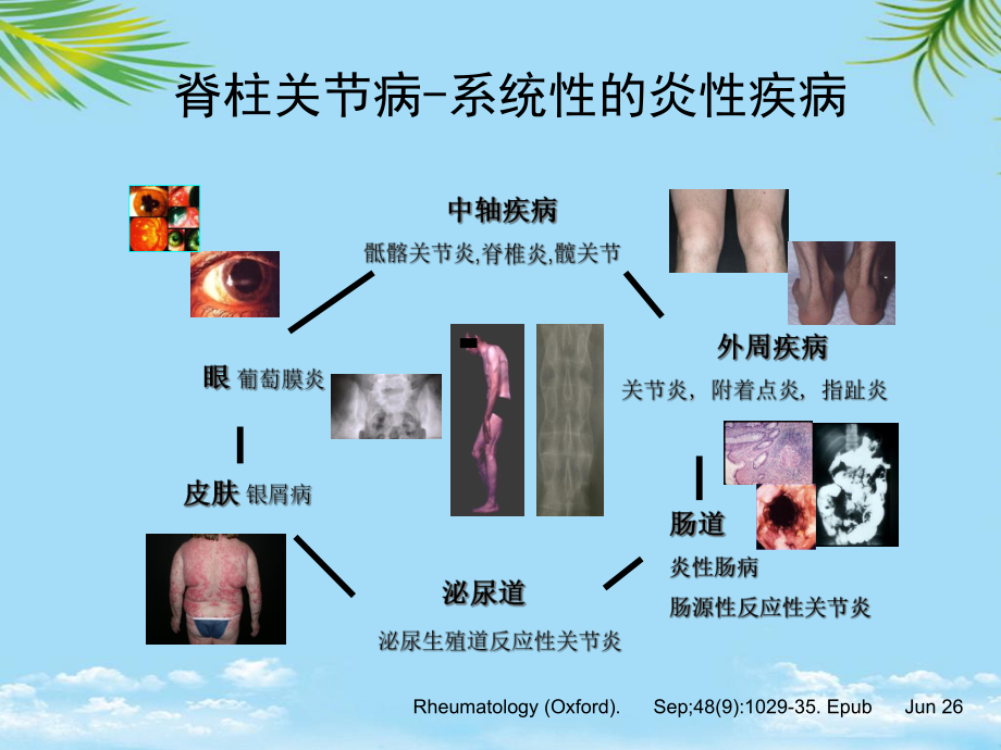 教培用强直性脊柱炎不仅仅在脊柱课件.ppt_第2页