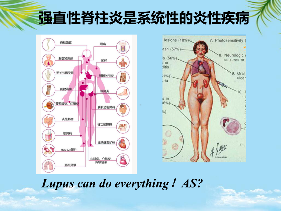 教培用强直性脊柱炎不仅仅在脊柱课件.ppt_第3页