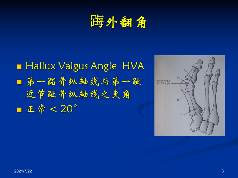 改良CHEVRON手术和AKIN手术课件.ppt_第3页