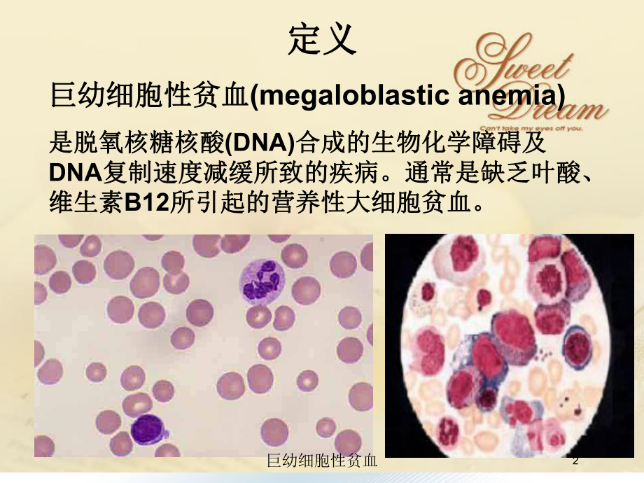 巨幼细胞性贫血培训课件.ppt_第2页