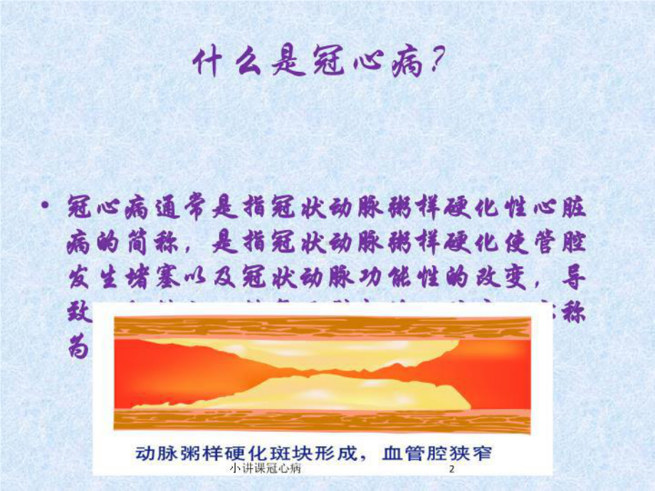 小讲课冠心病培训课件.ppt_第2页