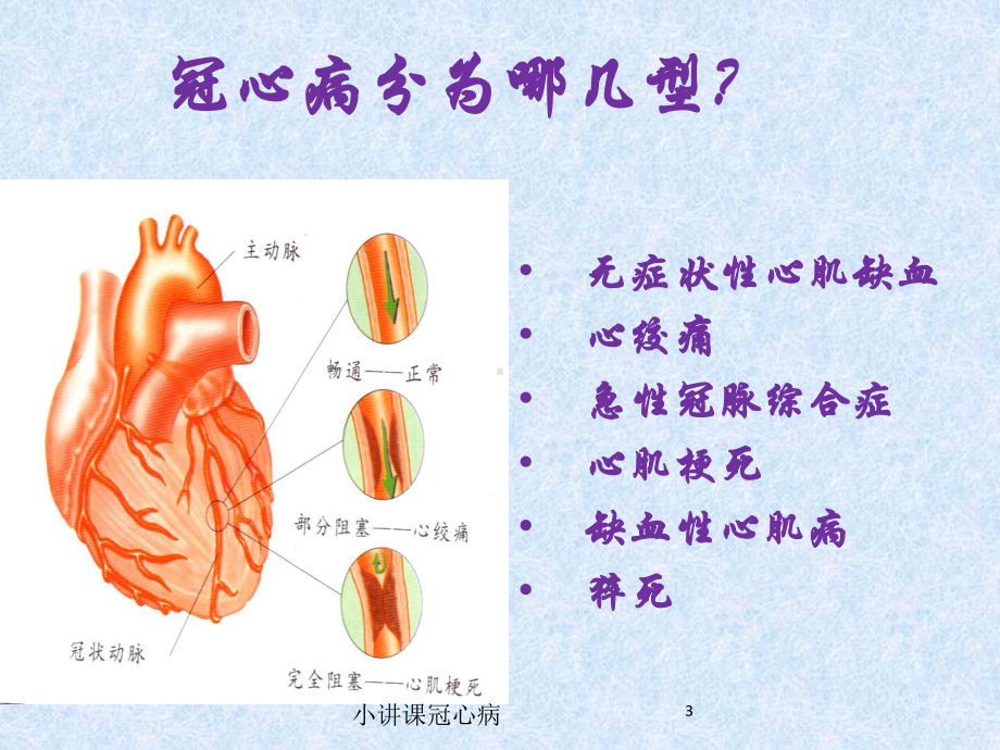 小讲课冠心病培训课件.ppt_第3页