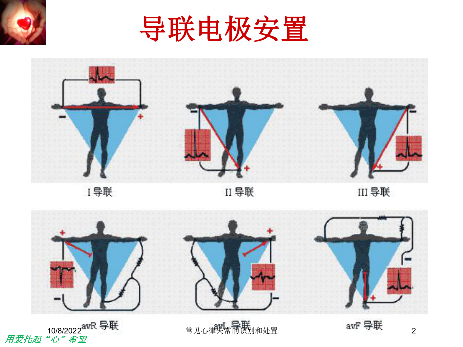 常见心律失常的识别和处置课件.ppt_第2页