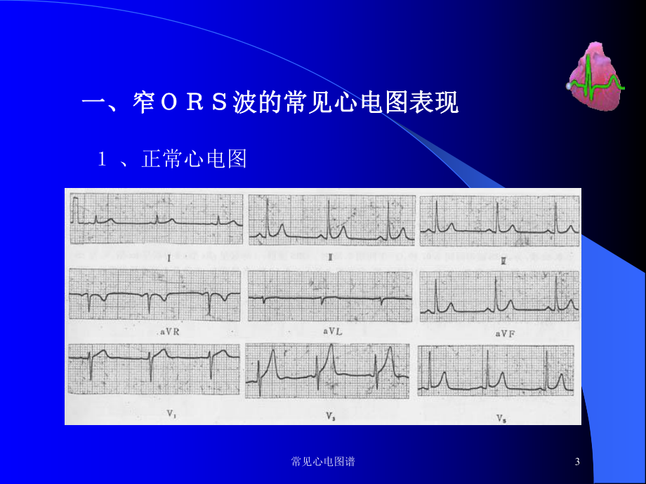 常见心电图谱培训课件.ppt_第3页