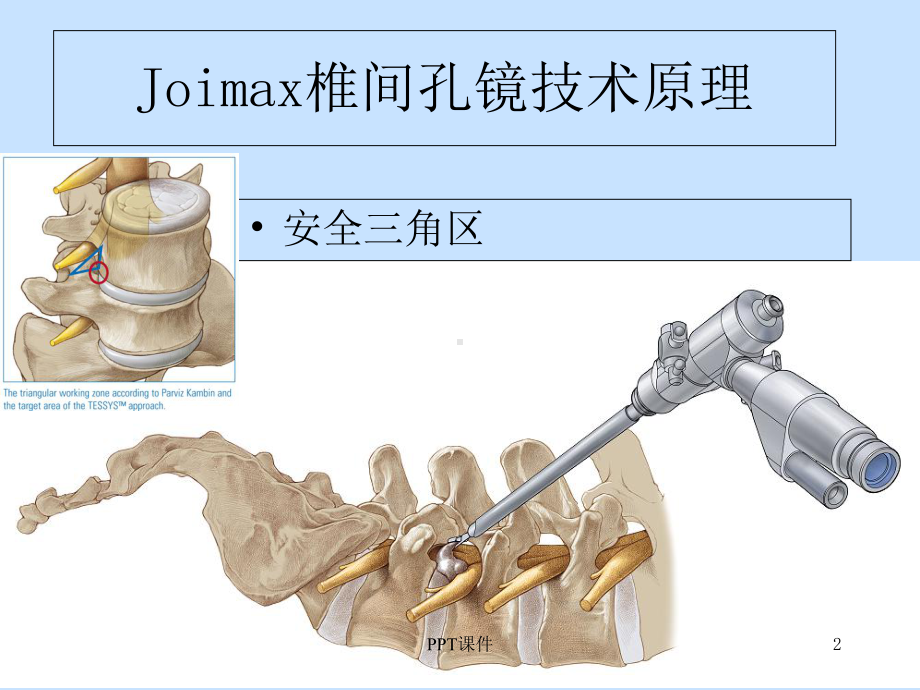 椎间孔镜手术操作方法-课件.ppt_第2页