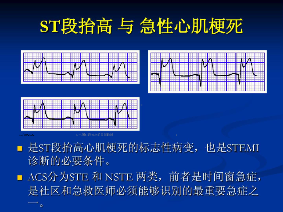 心电图ST段抬高的鉴别诊断培训课件.ppt_第3页