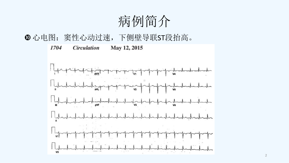 机械循环支持与心原性休克case课件.ppt_第2页