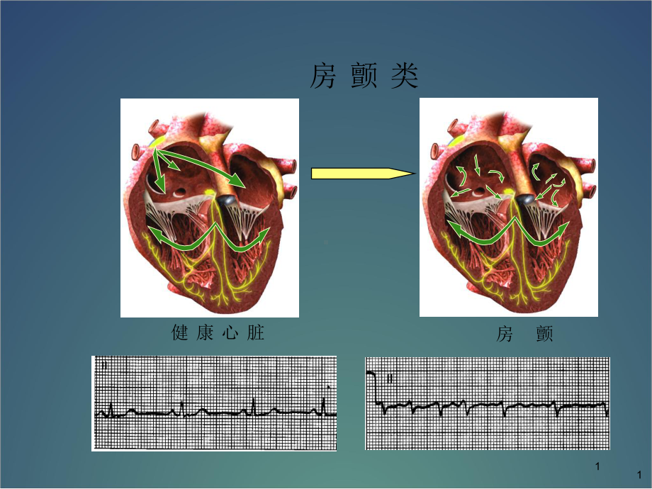 房扑与房颤心电图医学课件.ppt_第1页