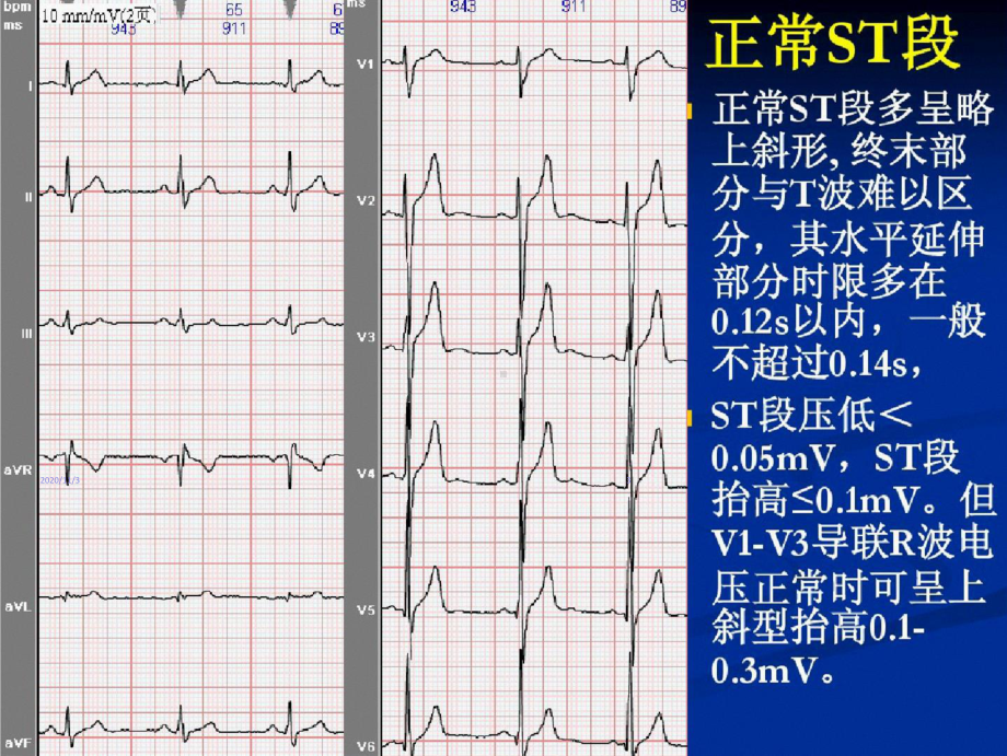 心电图ST段抬高的鉴别诊断课件.ppt_第3页