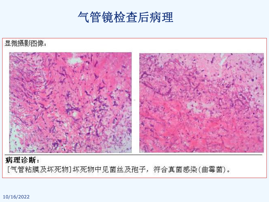 曲霉菌病的诊断课件.ppt_第3页