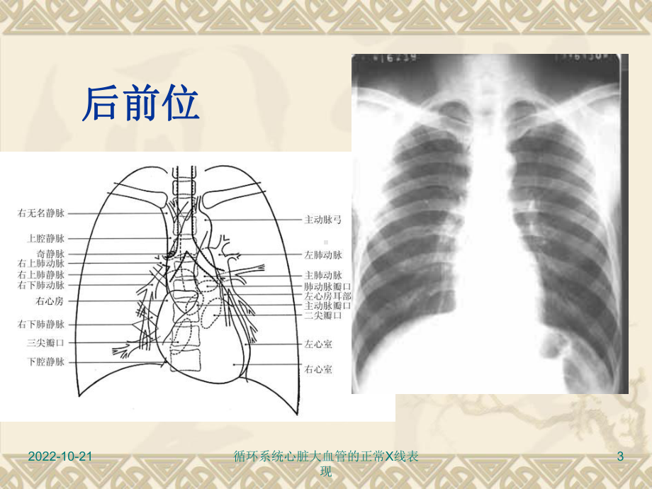 循环系统心脏大血管的正常X线表现课件.ppt_第3页