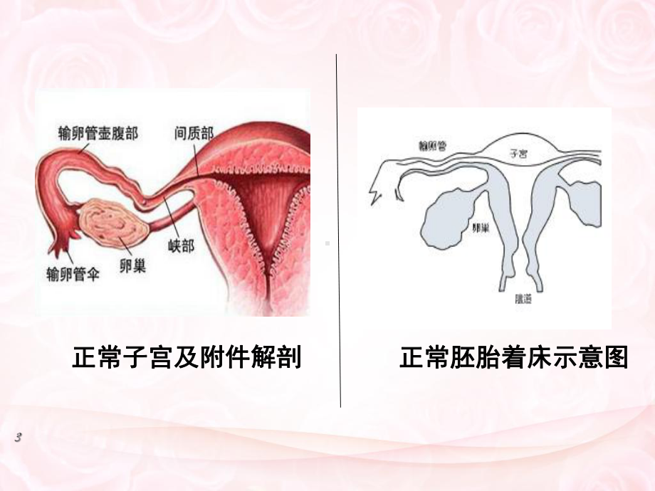 异位妊娠的护理教材课件.ppt_第3页