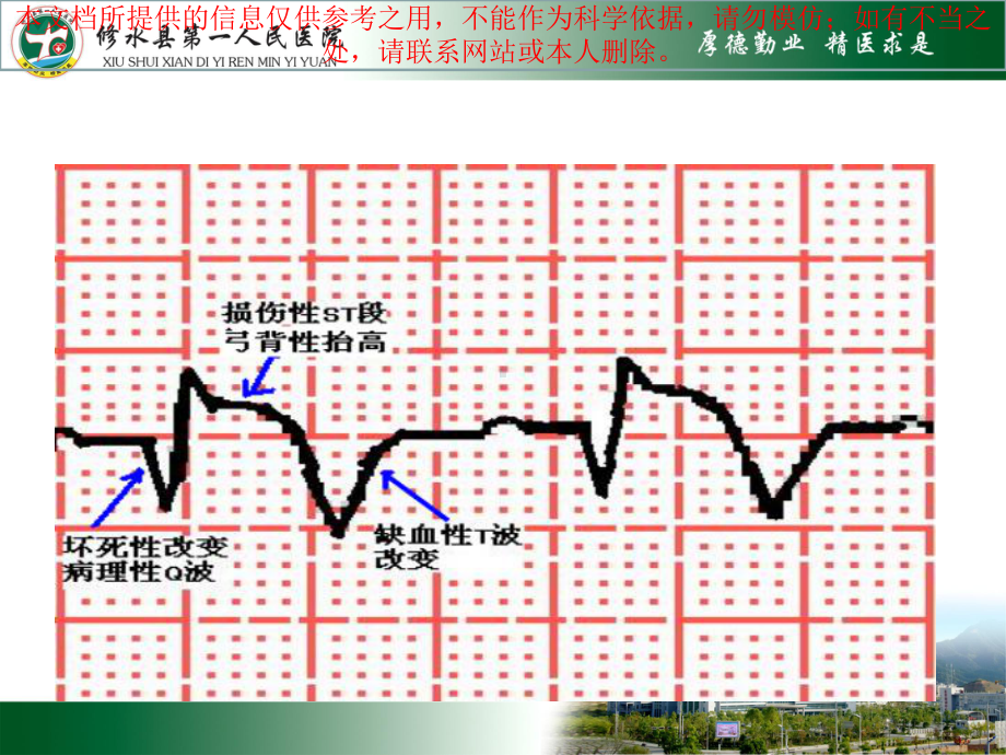 急性心肌梗死和常见心电图识别培训课件.ppt_第3页