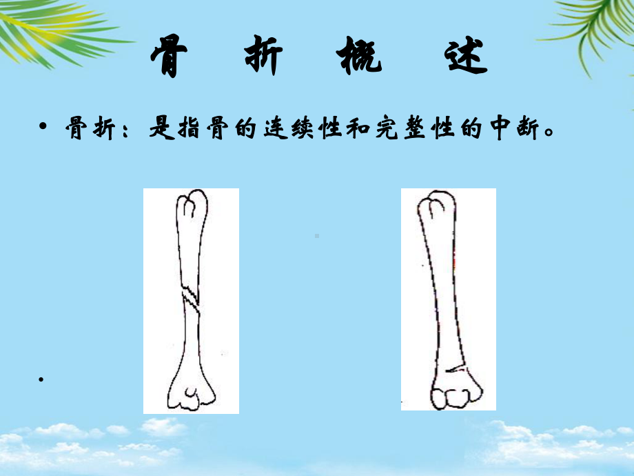 教培用运动系统疾病病人的护理课件.ppt_第2页