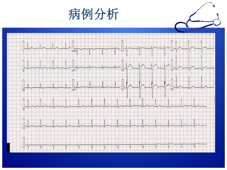 急性胸痛诊治流程课件.pptx_第3页