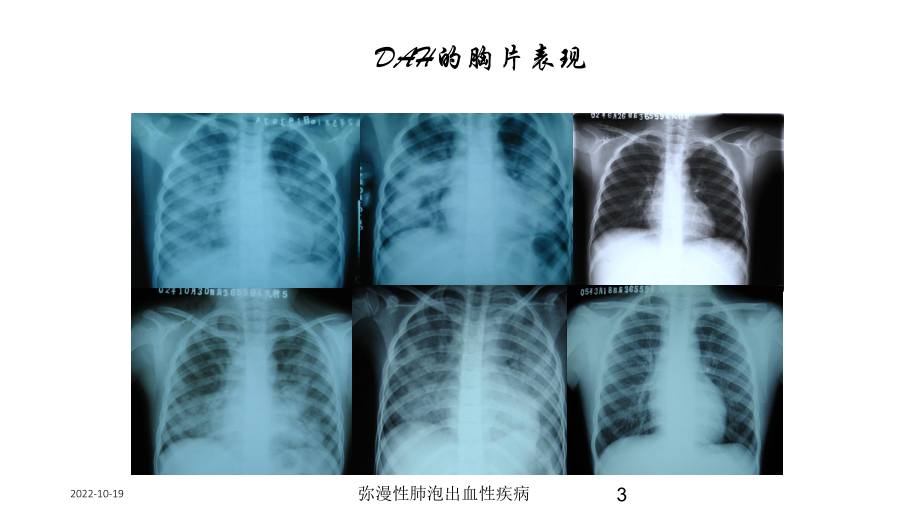 弥漫性肺泡出血性疾病培训课件.ppt_第3页