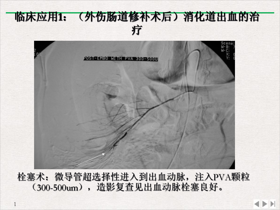 急性动脉性出血的介入治疗教学课件.ppt_第3页