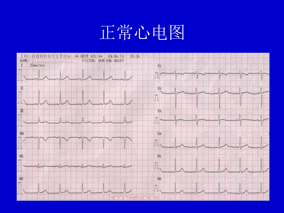 心律失常心电图表现课件.ppt_第2页