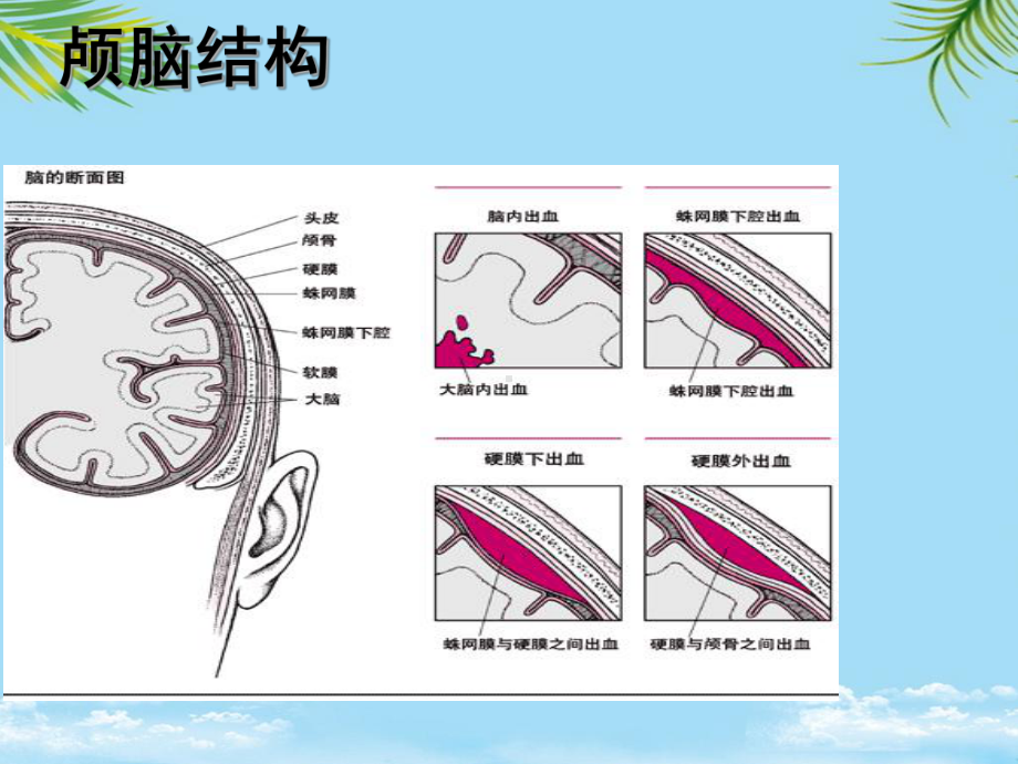 教培用蛛网膜下腔出血的护理概要课件.ppt_第2页