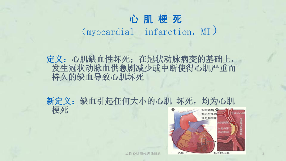 急性心肌梗死讲课课件.ppt_第2页