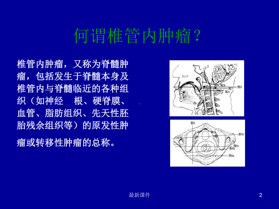 常见椎管内肿瘤及MRI表现课件.ppt_第2页