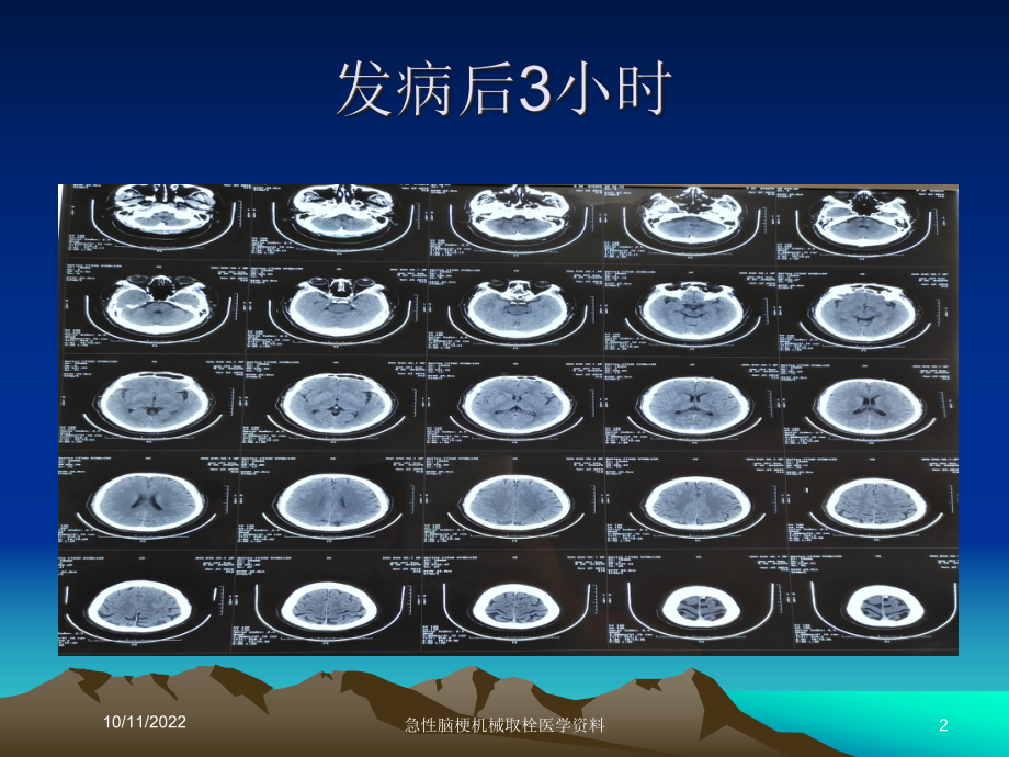 急性脑梗机械取栓医学培训课件.ppt_第2页