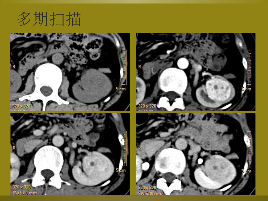 教学读片肾脏富血供肿瘤CT诊断教学文稿课件.ppt_第3页