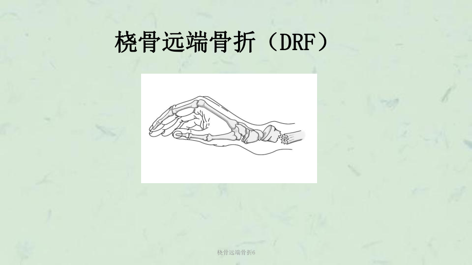 桡骨远端骨折6课件.ppt_第1页