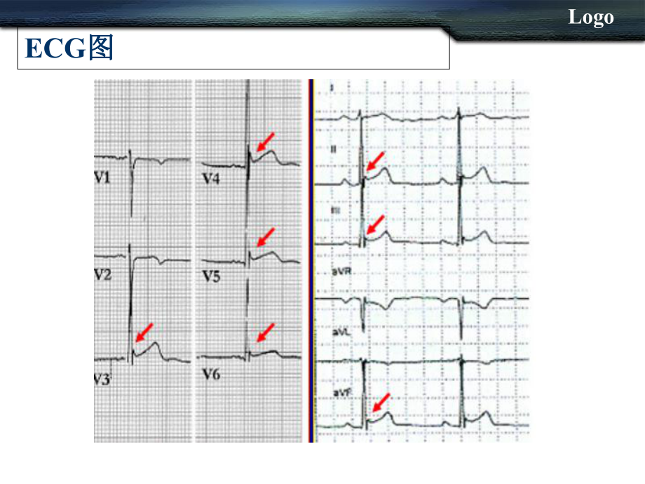 早期复极综合征学习课件.ppt_第3页