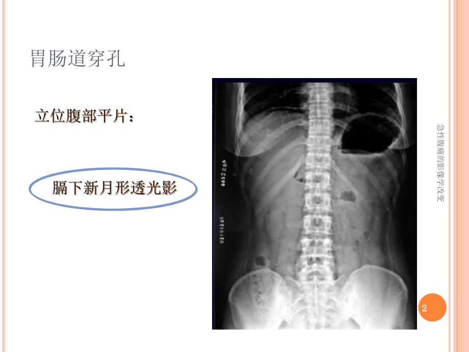 急性腹痛的影像学改变课件.ppt_第2页