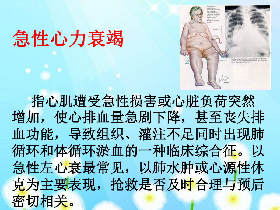 急性心力衰竭的急救护理课件.ppt_第3页