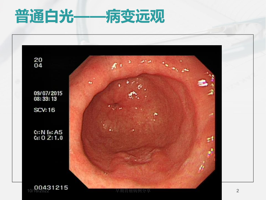 早期胃癌病例分享培训课件.ppt_第2页