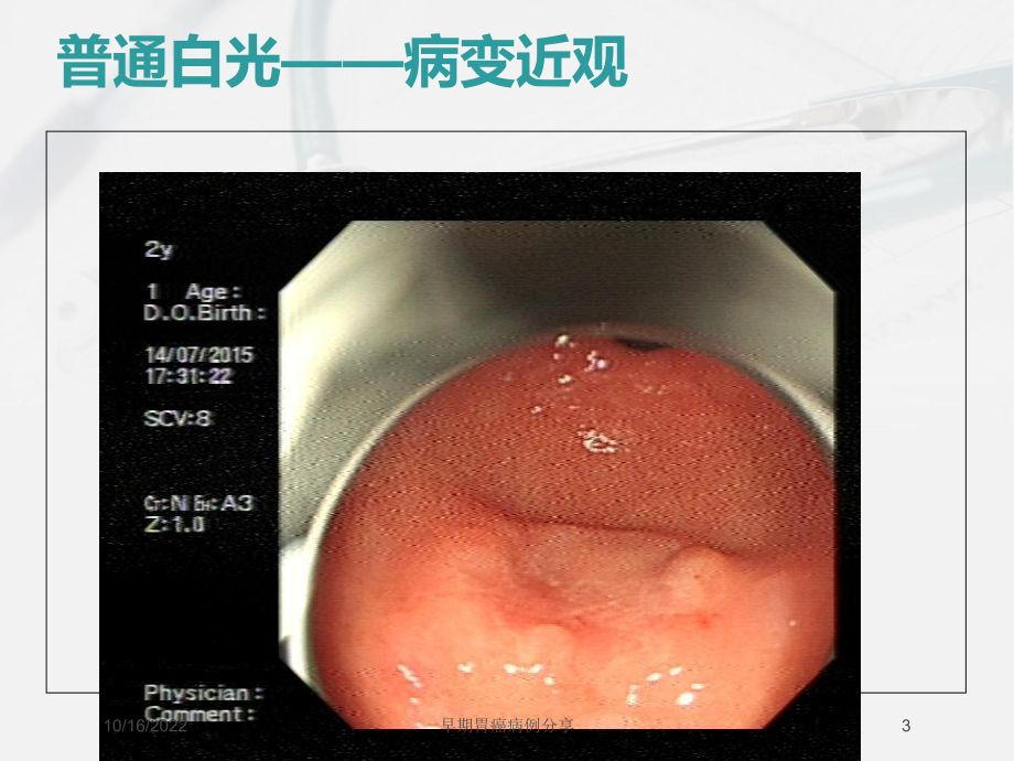 早期胃癌病例分享培训课件.ppt_第3页