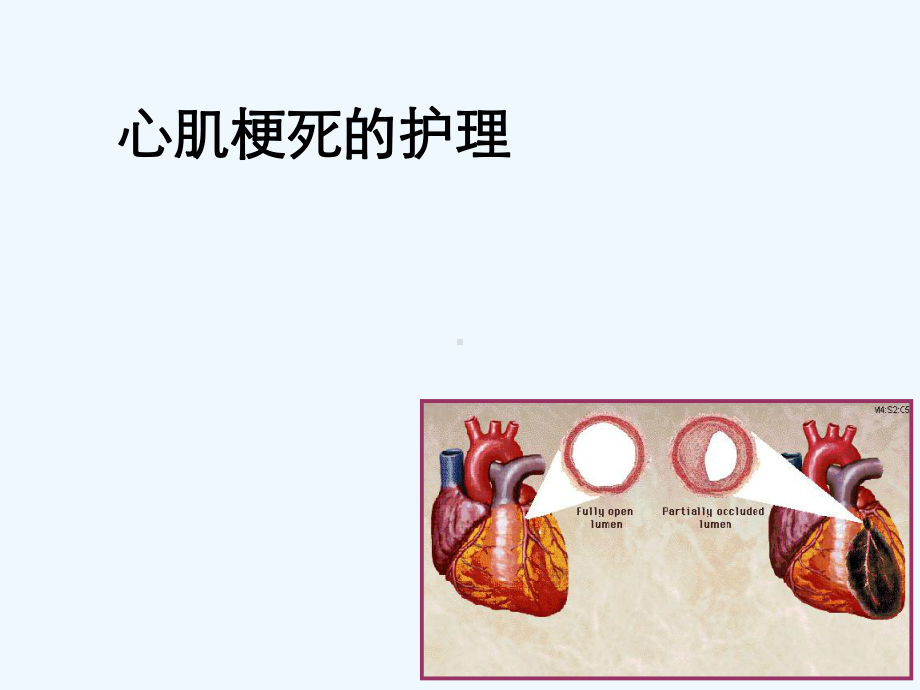 心肌梗死护理课件.ppt_第1页