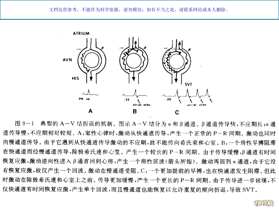 房室结房室折返性心动过速机制和心电图特点课件.ppt_第3页