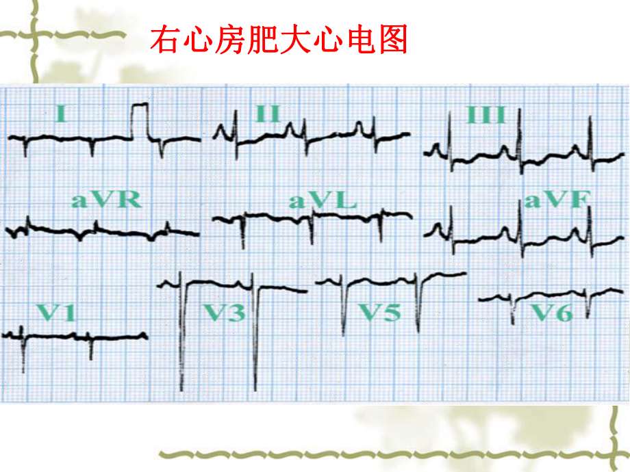 新版常见异常心电图课件.ppt_第2页