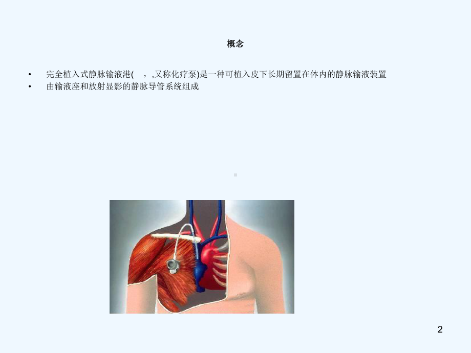 植入式静脉输液港的护理课件.ppt_第2页