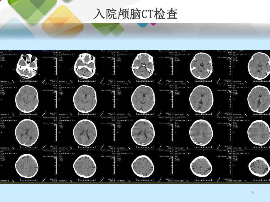 急性脑梗死动脉取栓治疗课件-2.pptx_第3页