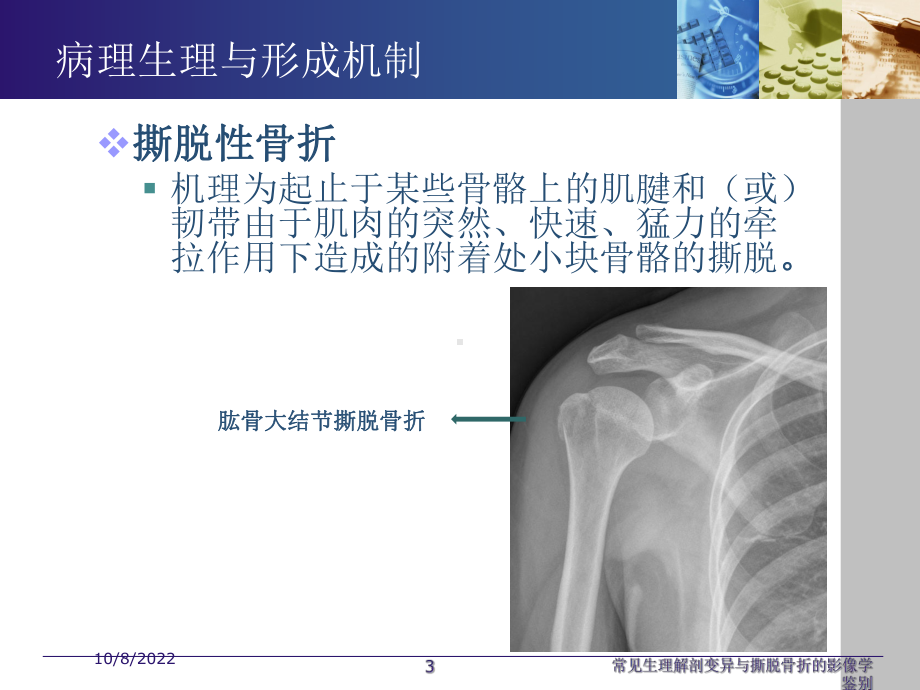 常见生理解剖变异与撕脱骨折的影像学鉴别培训课件.ppt_第3页