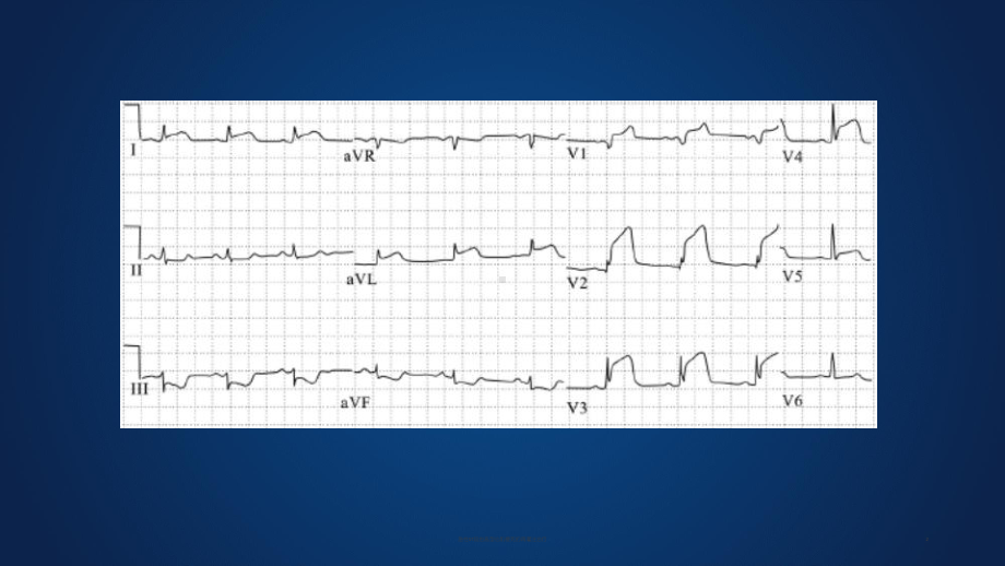 急性ST段抬高型心肌梗死的再灌注治疗培训课件.ppt_第2页