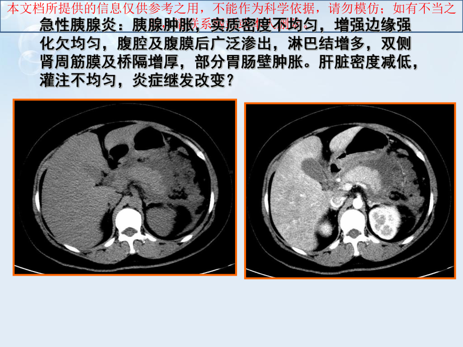 急性胰腺炎液体复苏培训课件.ppt_第2页