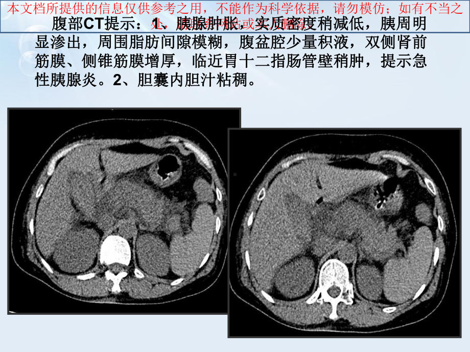 急性胰腺炎液体复苏培训课件.ppt_第3页