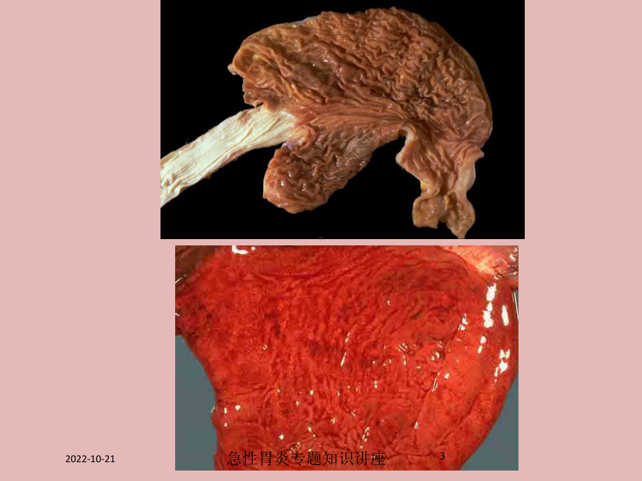 急性胃炎专题知识讲座培训课件.ppt_第3页
