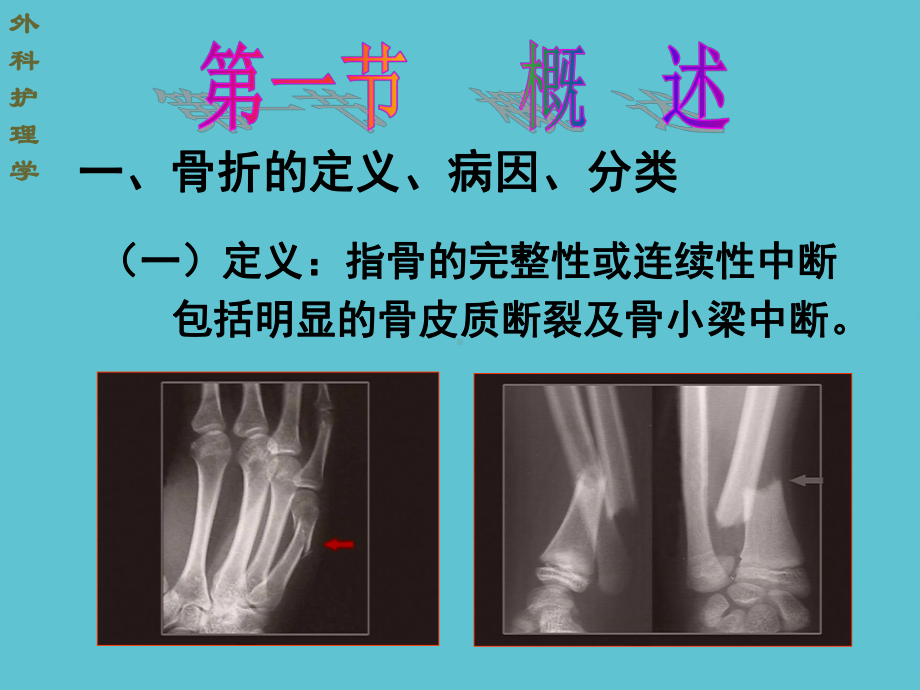 授课用-骨与关节疾病的护理课件.ppt_第3页