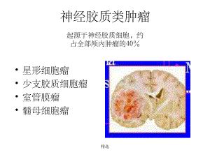 星形细胞瘤CT诊断课件.ppt