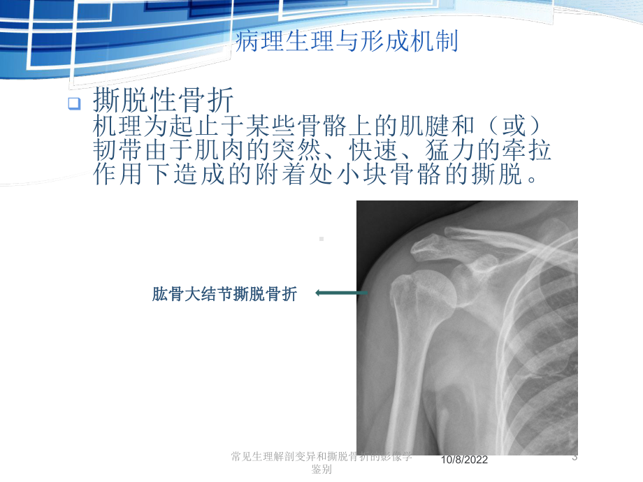 常见生理解剖变异和撕脱骨折的影像学鉴别课件.ppt_第3页